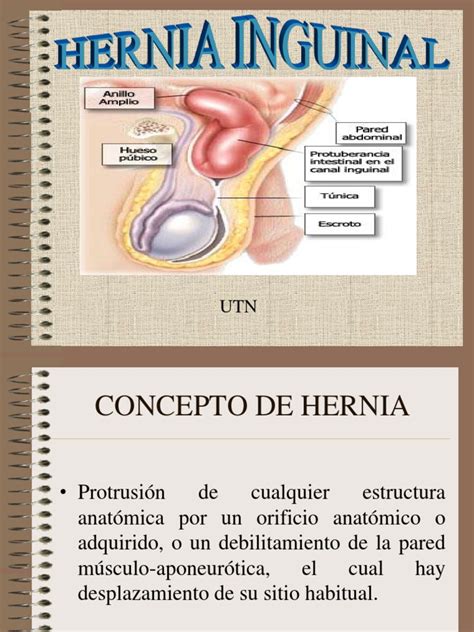 hernia inguinal derecha pdf